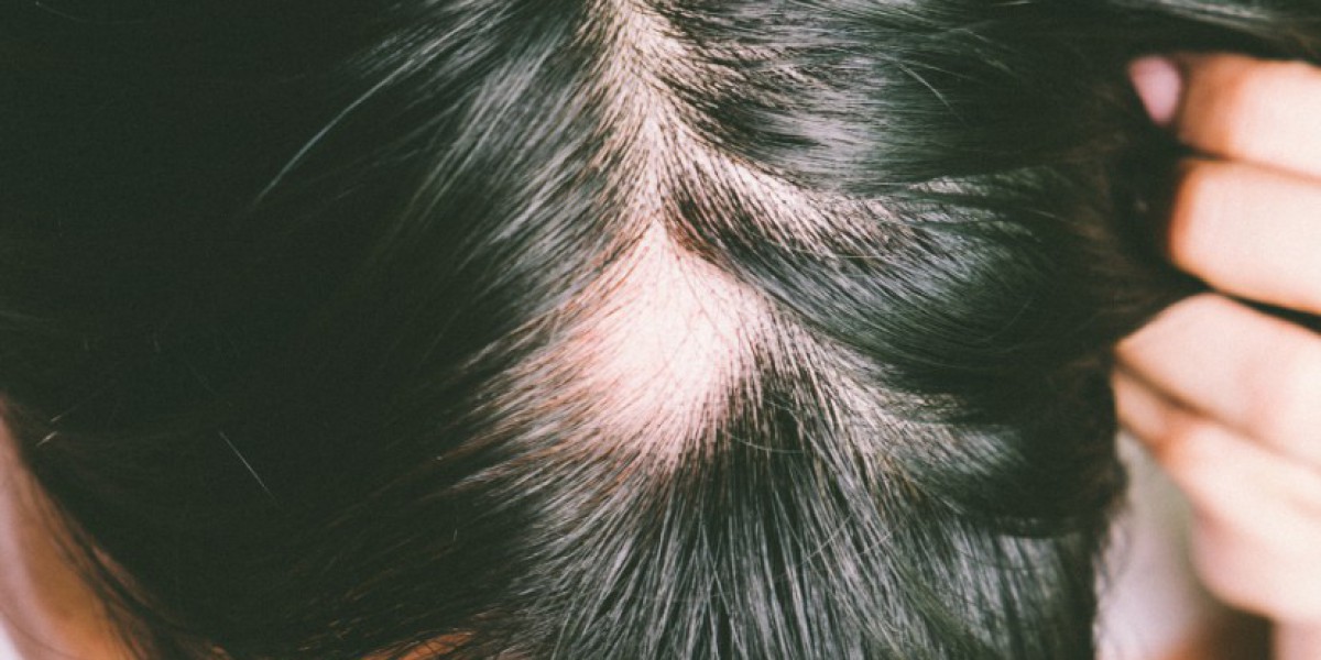 Alopecia Areata Market Size, Share & Growth 2034